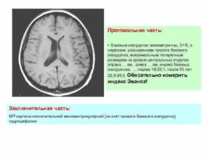 Асимметрия боковых желудочков головного мозга