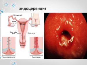 Половая жизнь при лечении цервицита