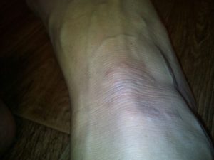 Воспаление (болячка на ноге)