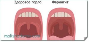 Температура 39.5 и красное горло