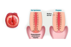 Эктропион шейки матки