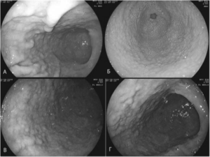 Очаговая атрофия слизистой оболочки желудка