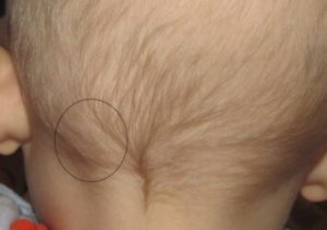 Увеличение лимфоузлов на голове у ребенка