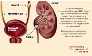 Боли после выхода камня из почки