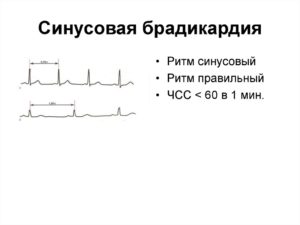 Брадикардия у ребенка