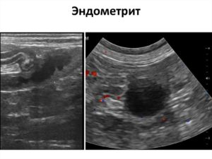 Хронический эндометрит и кальцинаты на повторном узи