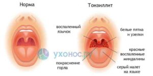 Болит горло не проходит больше двух недель