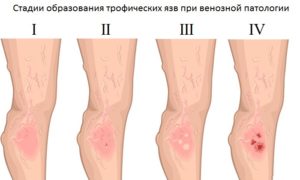 Воспаление (болячка на ноге)