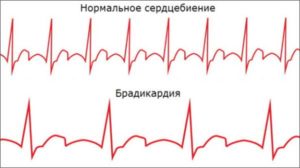 Брадикардия у ребенка