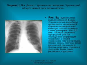 Единичное мелкое солитарное образование нижней доли левого лёгкого