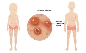 Ветрянка при беременности и оспины в половых органах