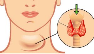 Запор и щитовидка - связь