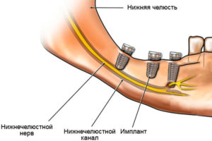 Задели нижнечелюстной нерв