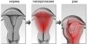 Гиперплазия эндометрия, фолликулярная киста, перименопауза, выскабливание