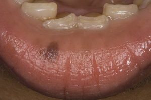 Белые полосы вдоль зубов на слизистой оболочки рта, облазит слизистая