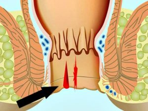 Зуд и влажность в заднем проходе
