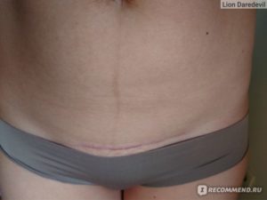 Задержка после кесарева сечения