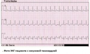 Синусовая тахикардия, высокое давление