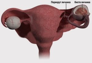 Киста яичника консультация