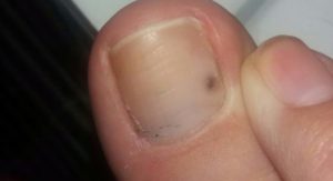 Чёрные точки на ногте на ноге