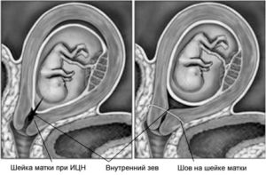 Внутренний зев воронкообразный