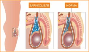 Возникновение варикоцеле от мастурбации