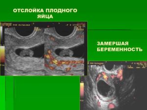 Отслойка плодного яйца 16х8мм