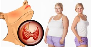 Ожирение при гипотиреозе