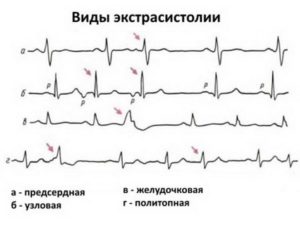 Экстрасистолия на фоне брадикардии