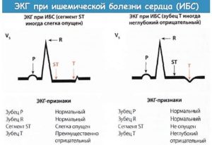 ЭКГ может ли не обнаружить заболевания сердца?