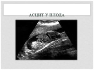 На 20 неделе беременности генерализованный отек и анемия у плода