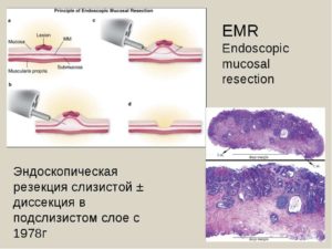 Эндоскопическая диссекция в подслизистом слое