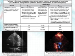 Результат УЗИ сердца: митральная регургитация 1 степени, трикуспидальная регургитация 1 степени