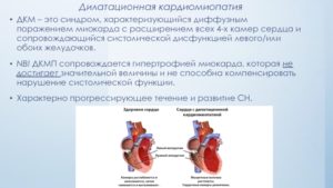 Кардиомегалия плода, кардиомиопатия