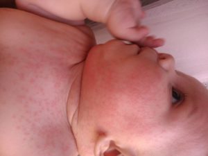 Сыпь у 8 месячного ребенка