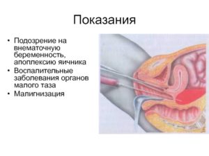 Подозрение на внематочную беременность