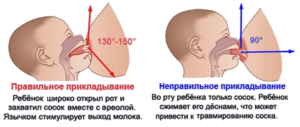 Кровь из соска при кормлении грудью