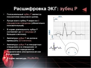 ЭКГ, сердце, расшифровка