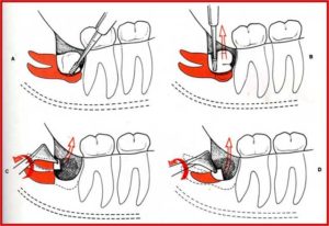 Снятие швов после удаления ретирированного зуба, дырка в десне