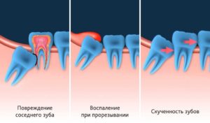 Белые точки на десне после удаления зуба мудрости