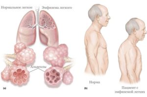 Вздутые лёгкие у ребёнка