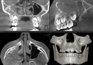 Синдром молчащего верхнечелюстного синуса