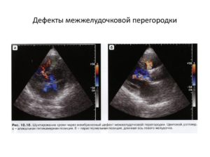 Выявлены септальные дефекты. Что это?