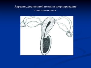 Атрезия девственной плевы операция