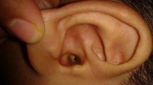 У ребенка пленка в ухе с отвертием посередине