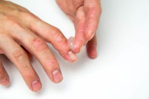 Атопический дерматит, грибок кожи рук и ногтей, что это?