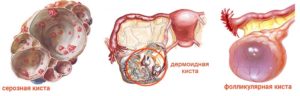 Боли в груди и киста левого яичника