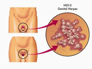 Секс при генитальном герпесе