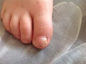 Ногти на ногах ребенка неправильной формы