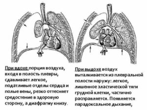 Боли в сердце при смехе и выдохе